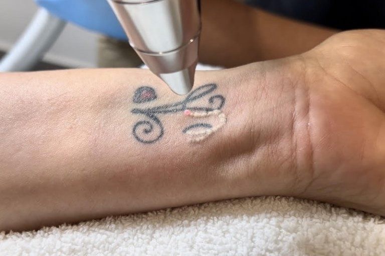 Eliminacion de tatuajes